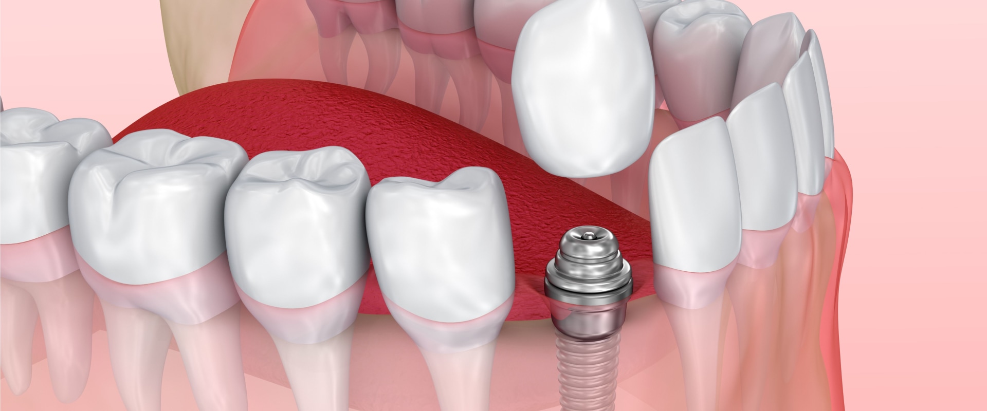 How Much Pain Can You Expect After a Tooth Implant Surgery?