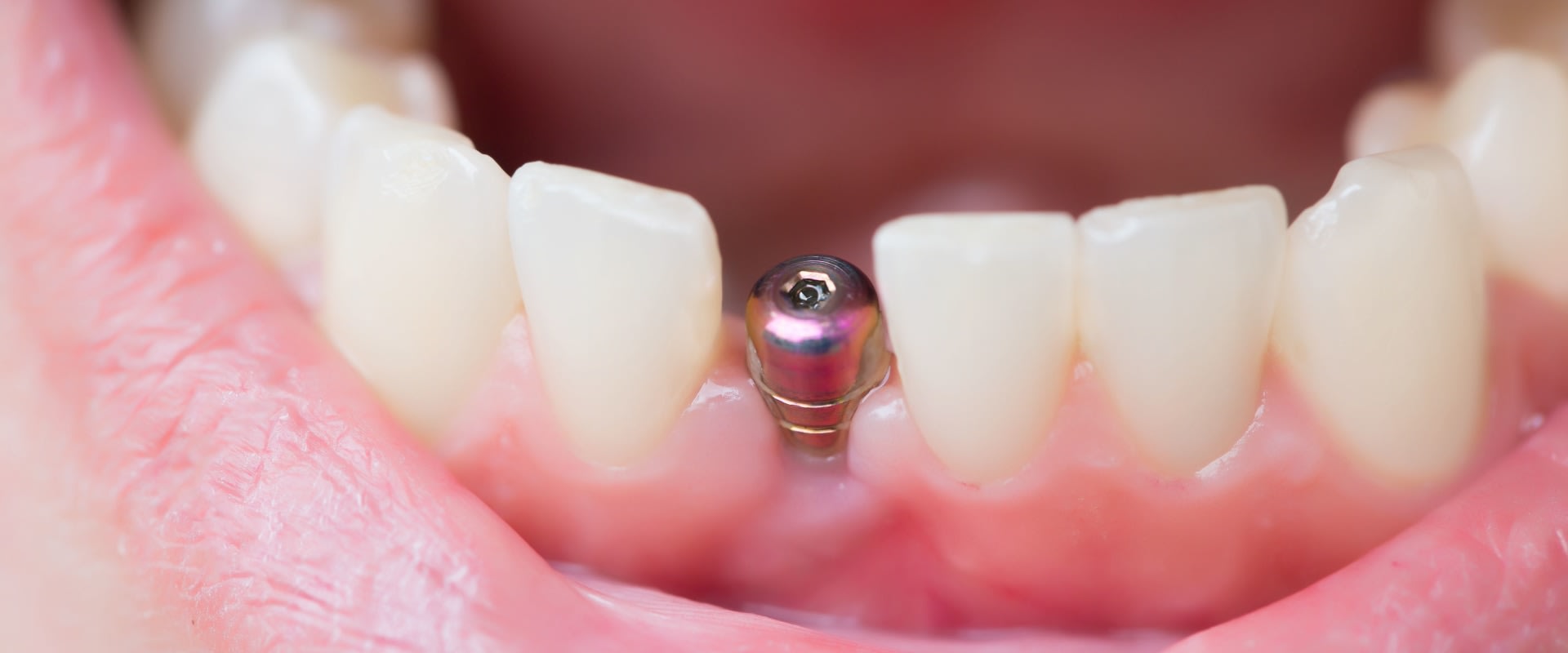 Can You Get a Dental Implant in One Day?