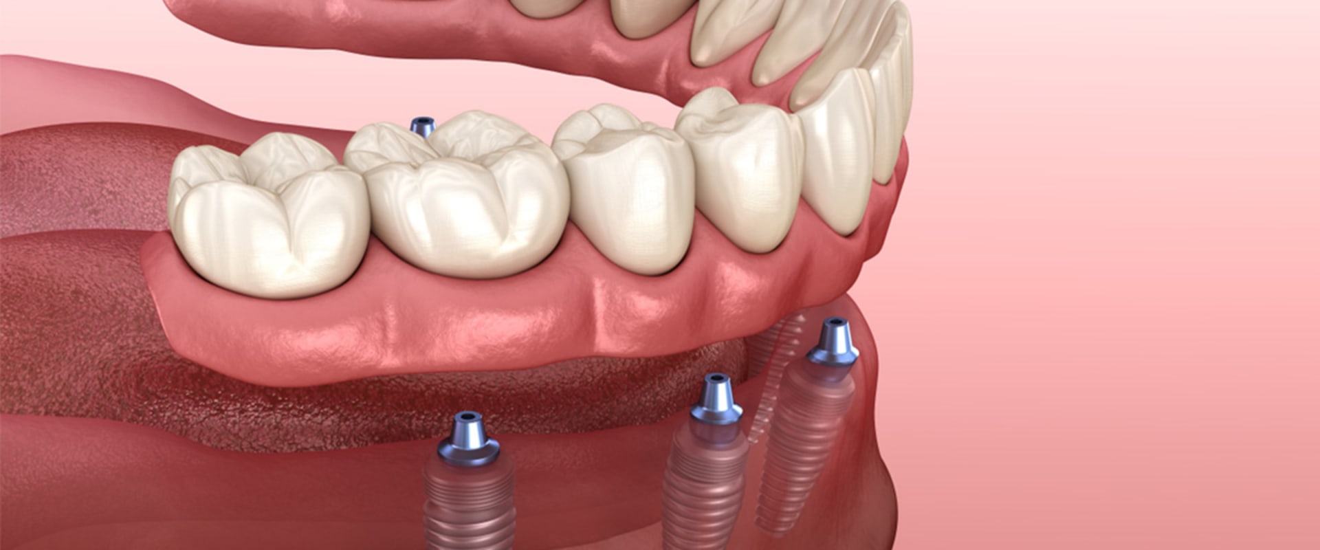 How Many Implants Does it Take to Replace All Your Teeth?