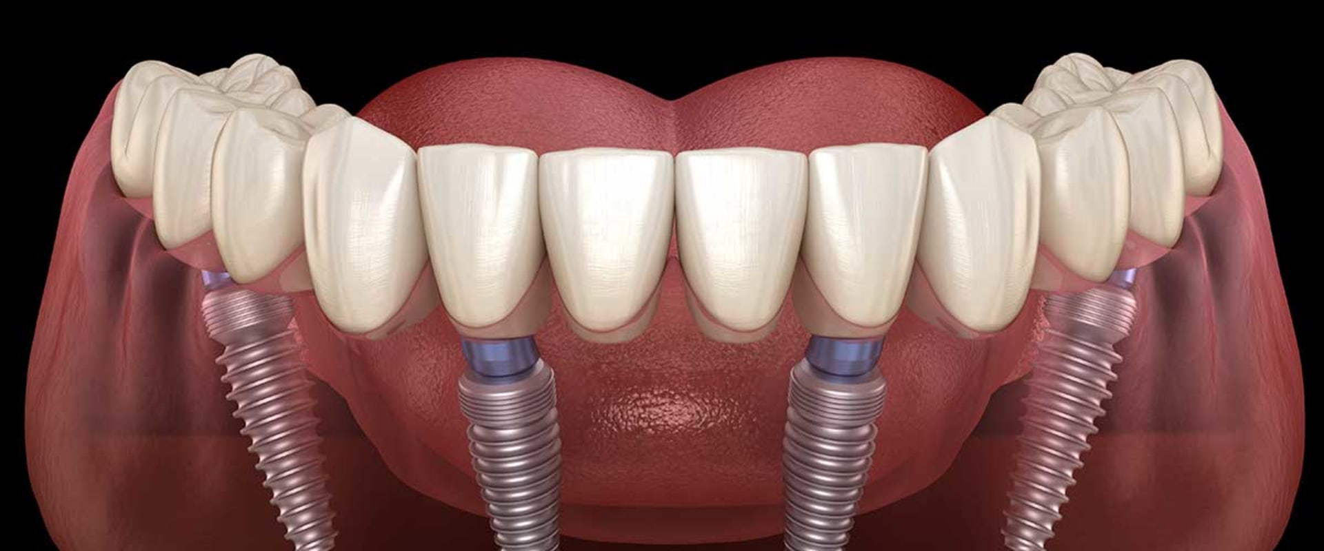 Who is Not a Candidate for All-on-4 Dental Implants?