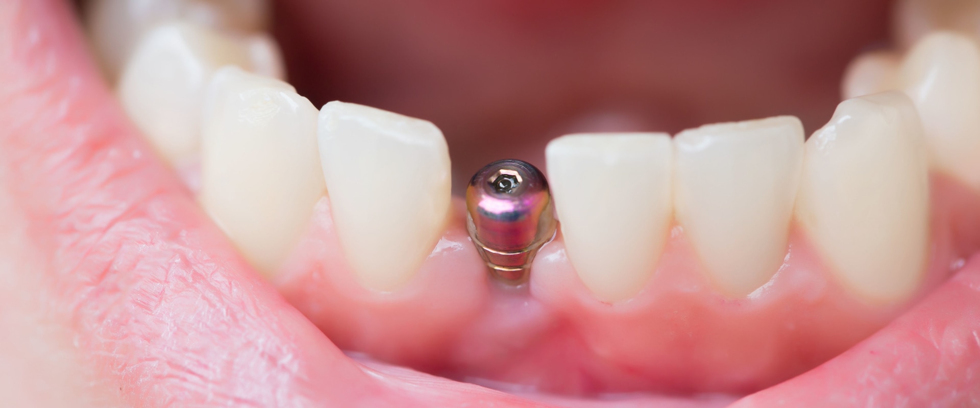 How Long Does It Take to Recover from Dental Implant Surgery?