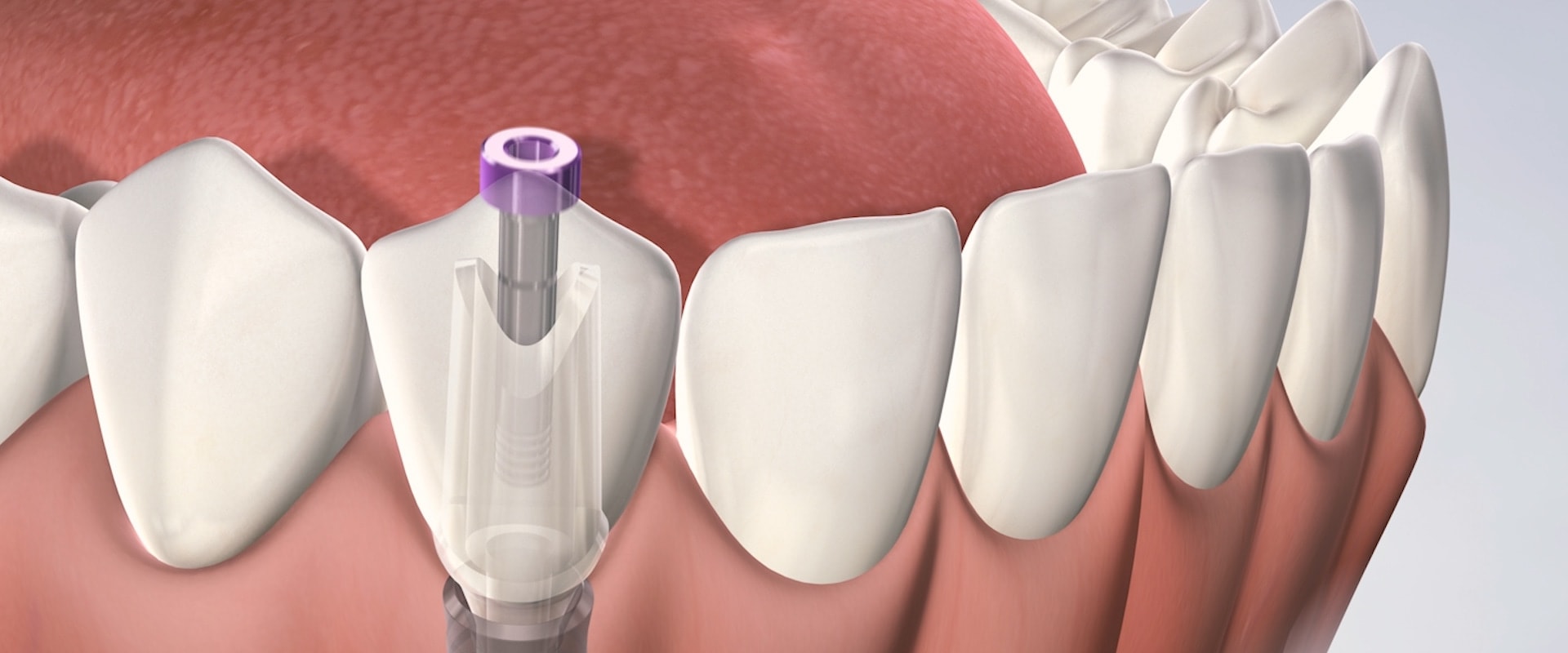 Is a Dental Implant More Painful Than a Tooth Extraction?