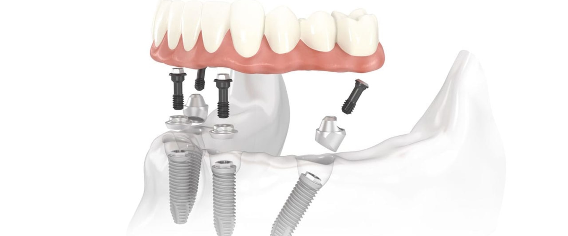 Who is a Good Candidate for All-on-Four Dental Implants?