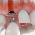 What to Expect After Getting a Dental Implant