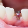 What to Expect the Day After Dental Implant Surgery