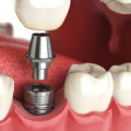 How Long Does a Tooth Implant Surgery Take?