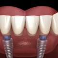 What Are All-on-4 Dental Implants and How Many Teeth Do They Replace?