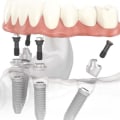 Who is a Good Candidate for All-on-Four Dental Implants?