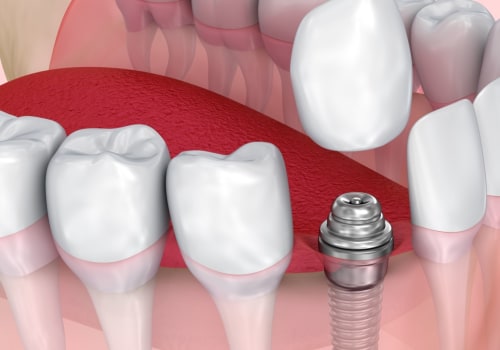 How Much Pain Can You Expect After a Tooth Implant Surgery?