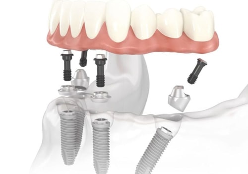 Can You Get a Dental Implant in One Day?