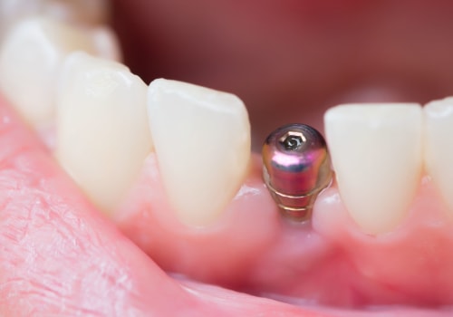 What to Expect Immediately After Dental Implant Surgery