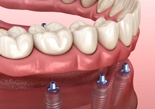 How Many Implants Does it Take to Replace All Your Teeth?