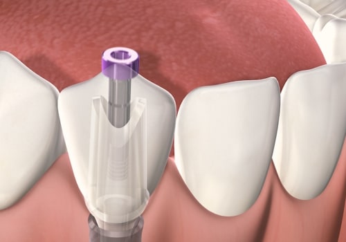 Is a Dental Implant More Painful Than a Tooth Extraction?