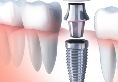 5 Things You Should Not Do After Dental Implant Surgery