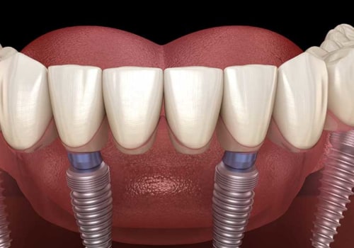 What Are All-on-4 Dental Implants and How Many Teeth Do They Replace?