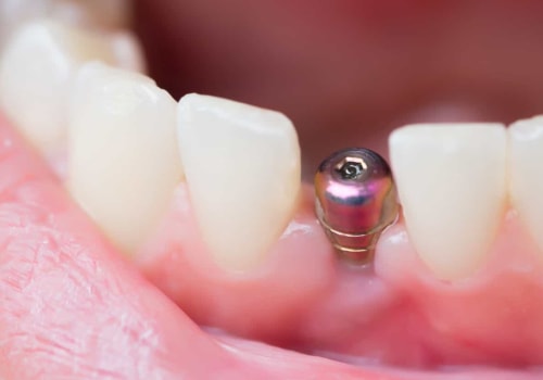 How Long Does Pain Last After a Dental Implant?